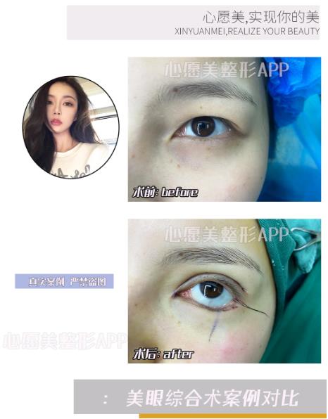去整容app心愿美割双眼皮可靠吗