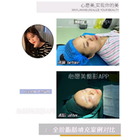 心愿美app自体脂肪填充效果如何