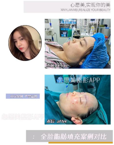 美容app整形平台分享全脸脂肪填充几天消肿?