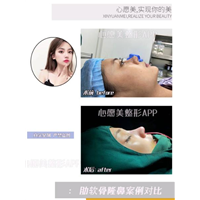 做完鼻部综合要注意什么?心愿
