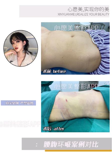 腰腹吸脂手术后伤口会疼多久呢?
