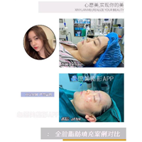 美容app整形平台分享全脸脂肪填充几天消肿?