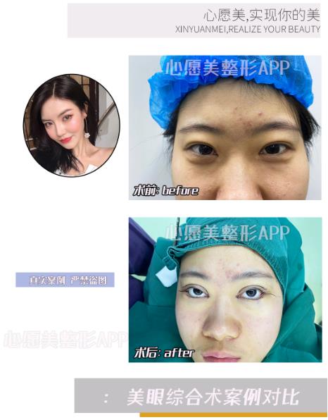 整形平台软件分享做芭比双眼皮会留疤吗