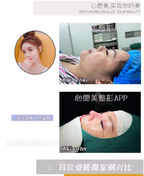 鼻梁骨歪了怎么办心愿美整形APP告诉你