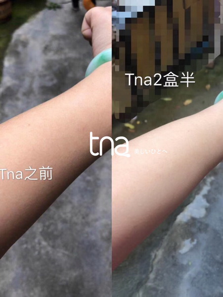 Tna美白