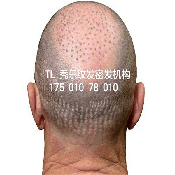 纹发是什么，北京纹发价格