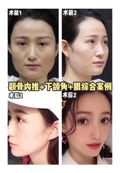 上海颧骨宽整形