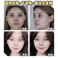 上海颧骨宽整形