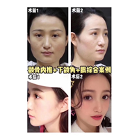 上海颧骨宽整形