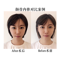 韩国磨骨专家