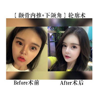 上海做磨骨哪家安全