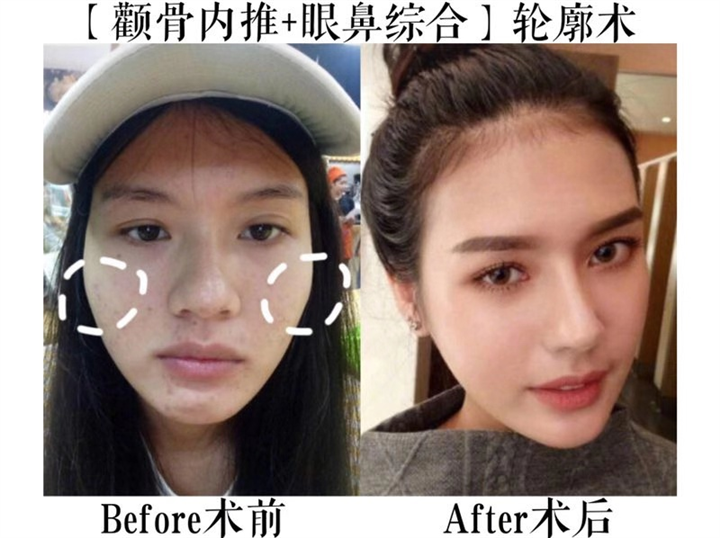 上海磨骨专家