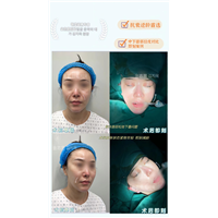 金志昱中下面部拉皮案例