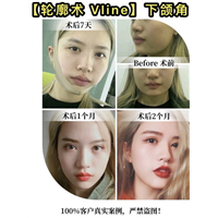 上海做磨骨哪家安全