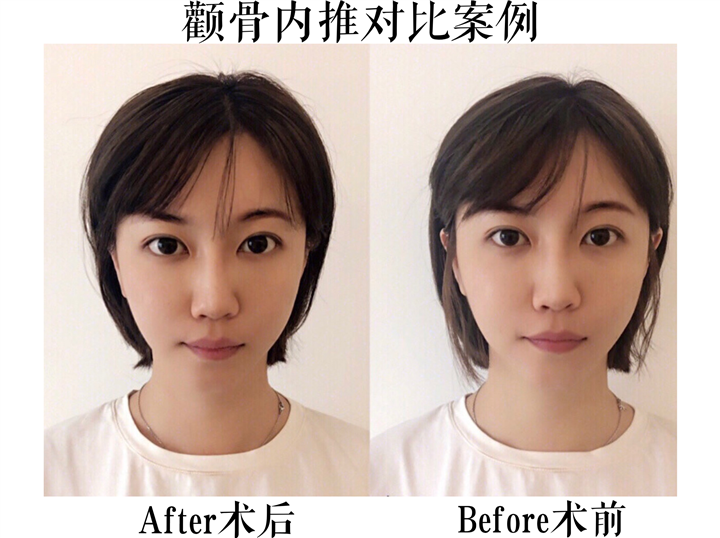 韩国磨骨专家
