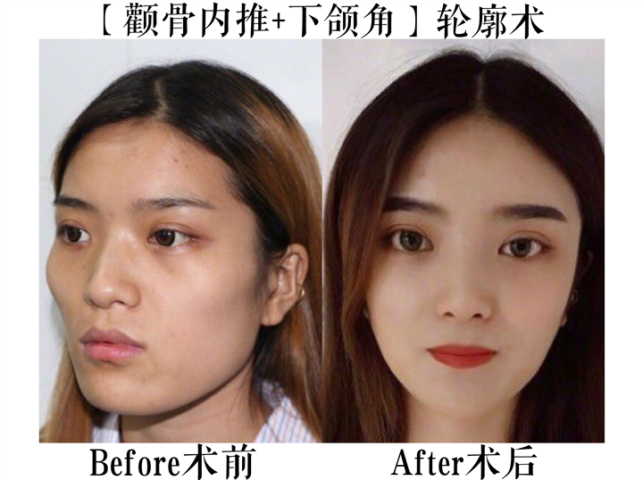 上海磨骨专家