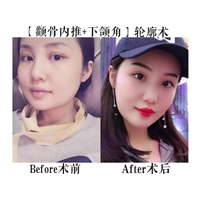 金一秀磨骨案例
