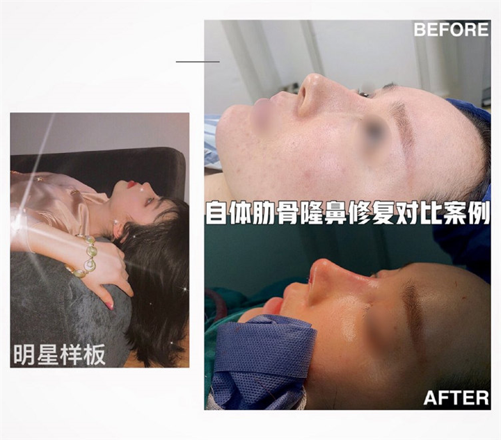 上海千美整形肋骨鼻综合