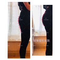 广州产后骨盆修复 