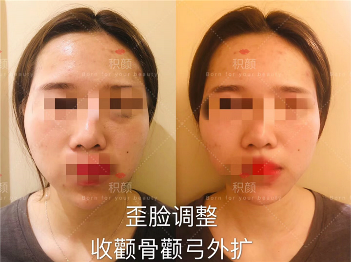 日式整骨歪脸矫正 