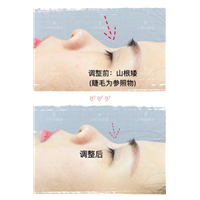 日式徒手鼻梁增高 