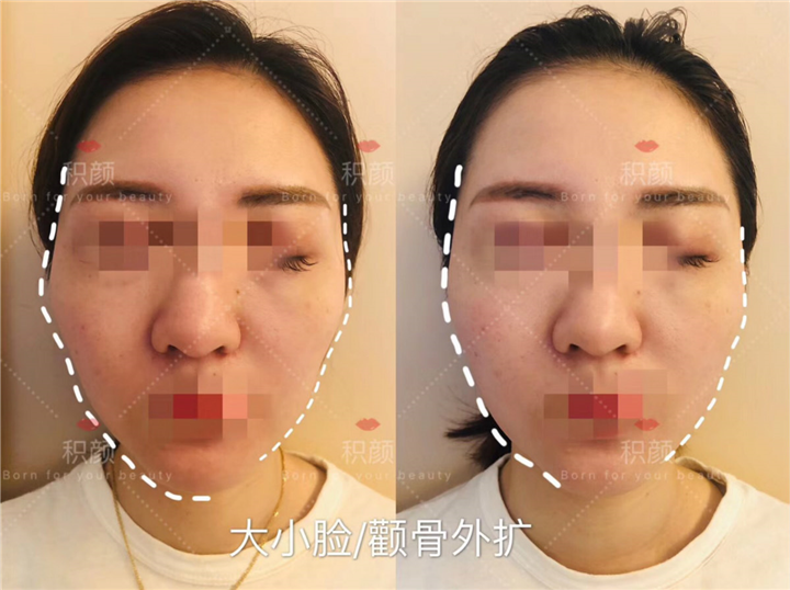 日式徒手整骨大小脸矫正 
