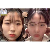 轮廓手术，颧骨缩小术，下颌角