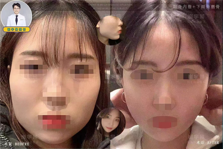 轮廓手术，颧骨缩小术，下颌角发达部位不同