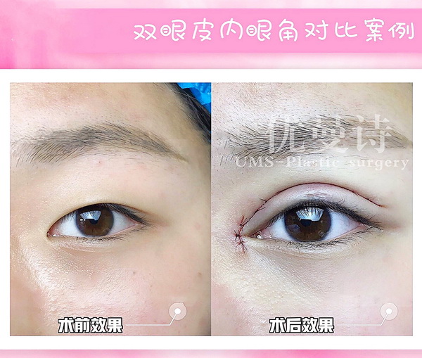 成都肋骨鼻专家