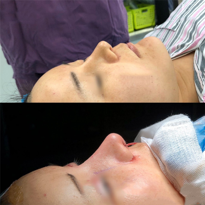 成都鼻整形医生 