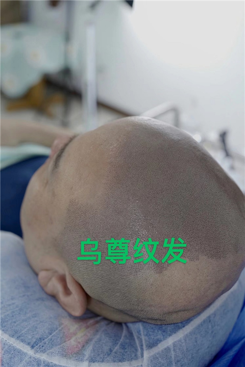 纹发和植发我该怎么选择秃顶怎么办河北乌尊纹发来谈谈