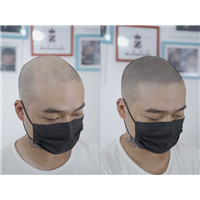 河北植发无法植发时千万别放弃