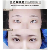 双眼皮种类全切和埋线哪种好？