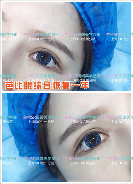 做眼部综合整形一共多少钱_兰州整形