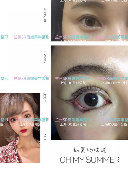 兰州眼综合整形医院_兰州整形美容