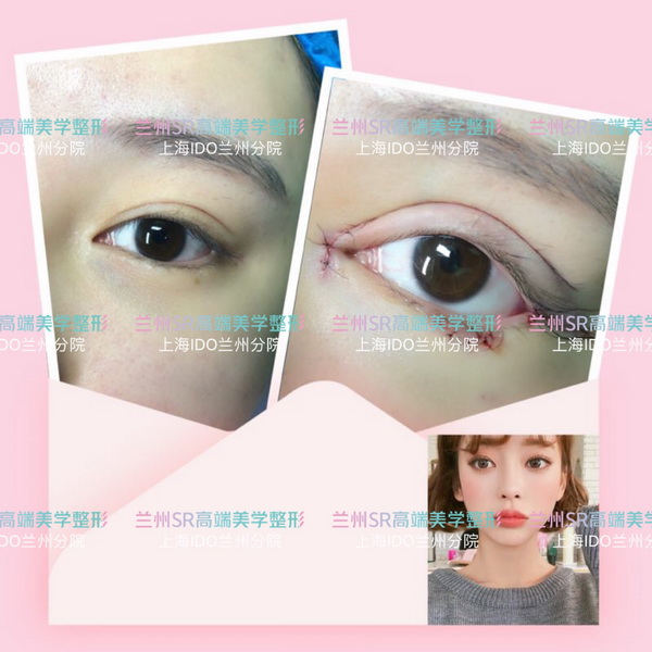 兰州割双皮哪个医院好_兰州整形医院