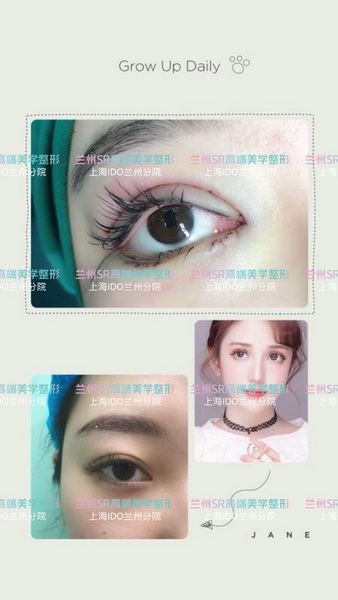 兰州眼部整形整形多少钱_兰州整形