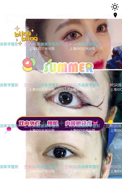 兰州做双眼皮哪里**_兰州整形医院