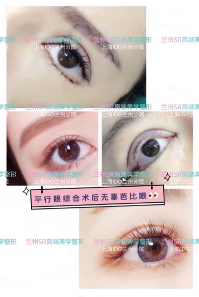 兰州做眼部综合整形哪家好_兰州整形