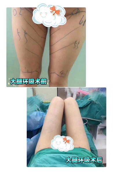 吸脂整形哪家医院比较好?_兰州整形