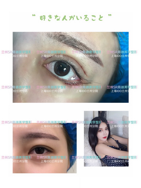 兰州做眼综合整形多少钱_兰州整形