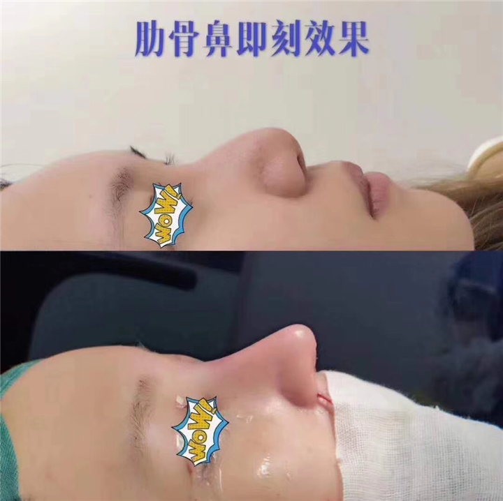 乐山肋软骨鼻整形 