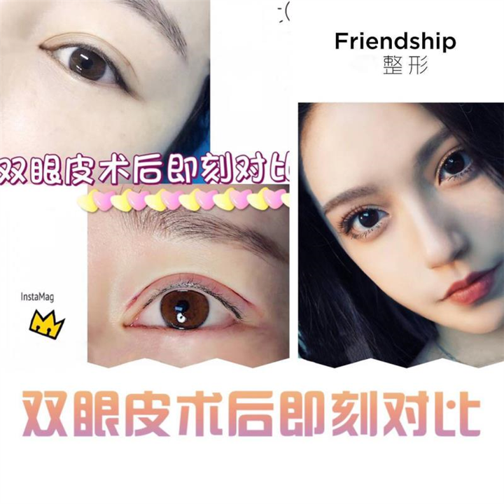 刘兴高双眼皮整形 