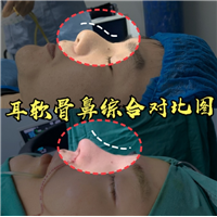 乐山耳软骨鼻综合整形 