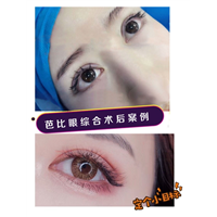 乐山芭比眼综合整形