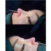 乐山肋骨鼻修复整形 