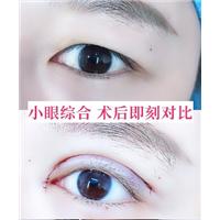 乐山眼部整形