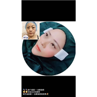 OV线雕脂肪移位培训