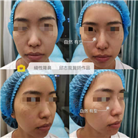 邱志龙医师隆鼻