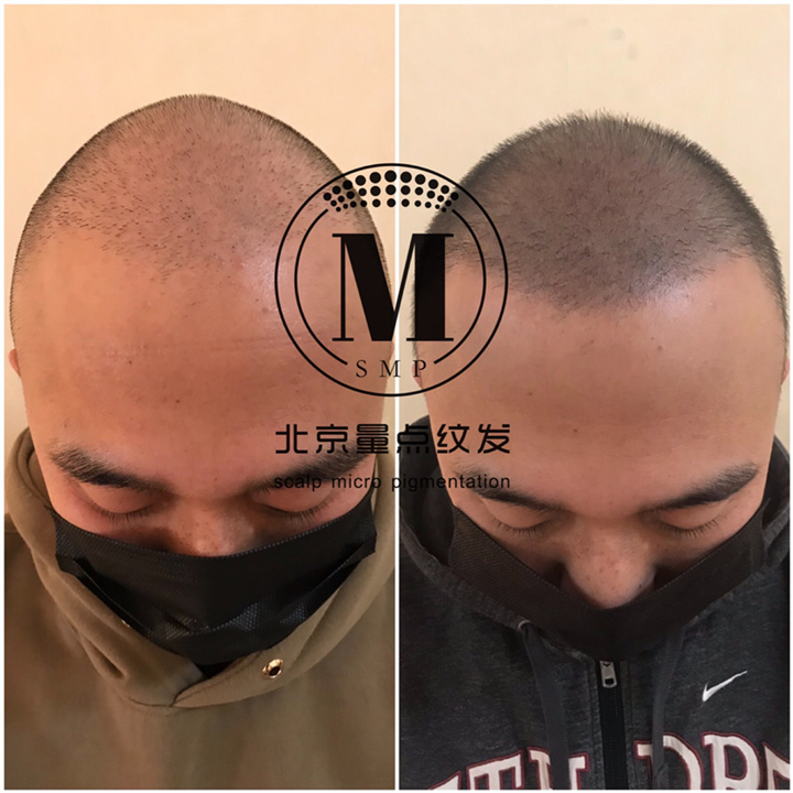 植发加密案例 